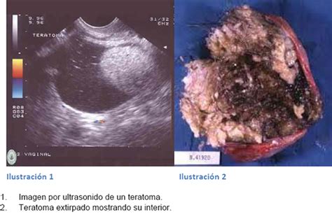 teratoma de ovário fotos